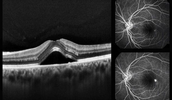 Laser Micropulsado Laser Micropulsado